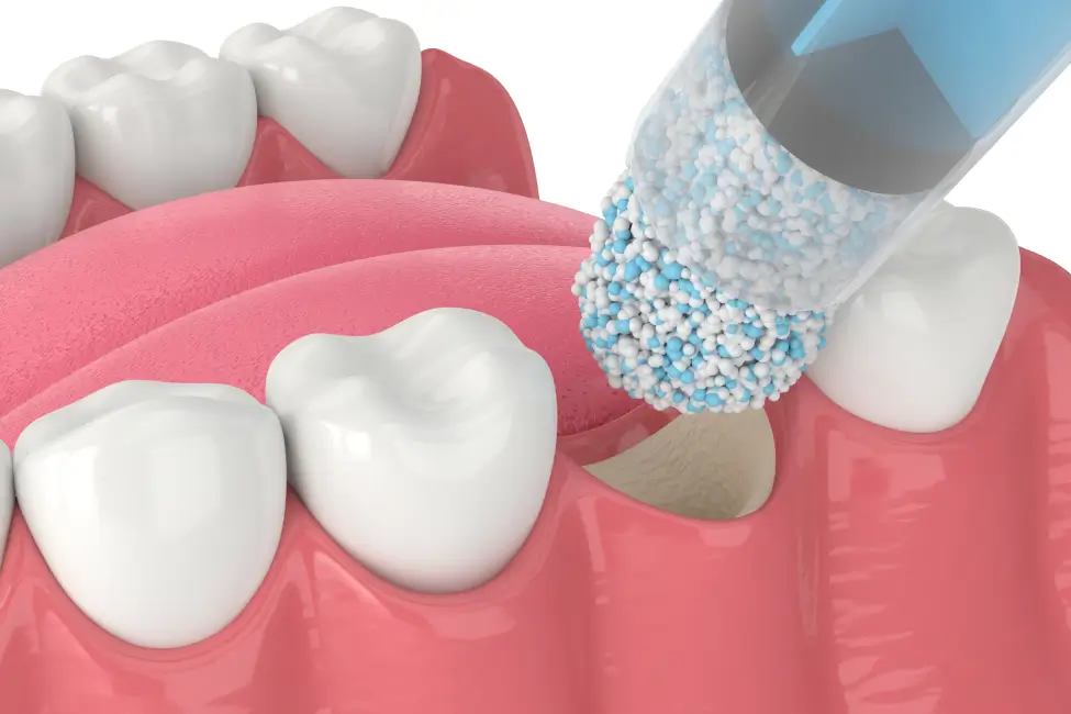 How Long Does It Take for Bone Regeneration to Heal?